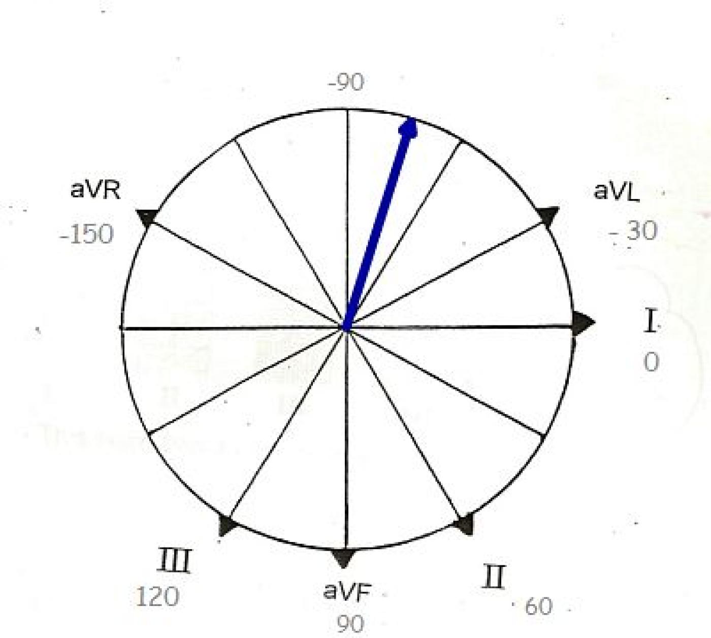 Previous Inferior Wall M.I. and Left Axis Deviaton ECG Guru
